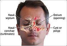 sinusitis otc