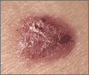 basal cell carcinoma