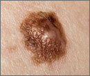 melanoma cancer