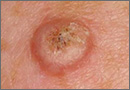 squamous cell carcinoma